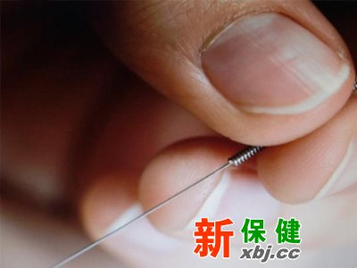 施針灸,緩解頭痛,分清類型